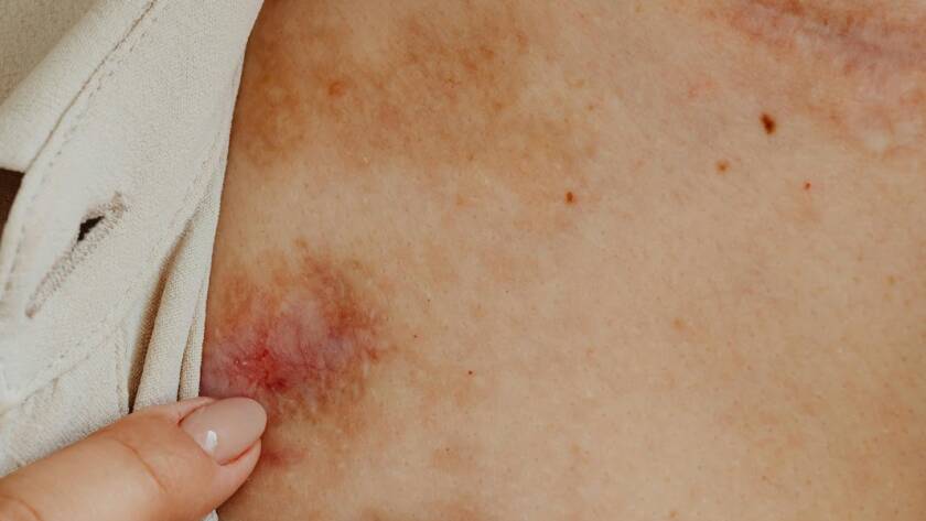skin-infections-2