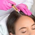 Why Professional Hair Treatment for Hair Loss Is Better Than Home Remedies